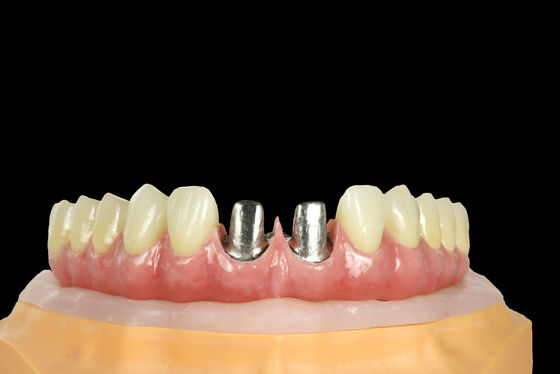 FDA Titanyum Köprüsü Diş İmplantı Taçlı Titanyum Çerçeve