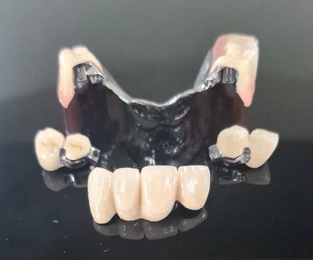 Metal Çerçeve Hassas Bağlama Aşırı diş protezi çıkarılabilir diş protezi