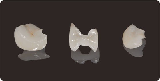 Kesinlik Diş Inlays ve Onlays Lityum Disilikat freze Onlay veneer