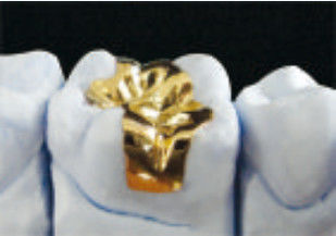 Mükemmel Dental Altın Onlay CE ve FDA Altın Inlays ve Onlays