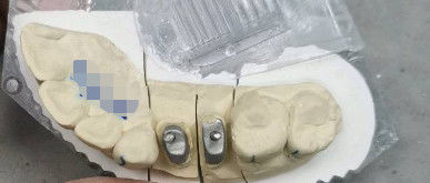 Metal / Doğal Ti Temel Taç Post Core Titanyum Taçlar Dişler için