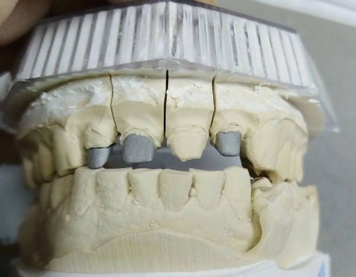 Post çekirdek değerli olmayan metal taç ve köprü güçlü dayanıklılık özelleştirilebilir
