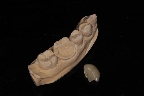 Diş Kompozit Onlay Veneer Yüksek Estetik Kompozit Veneer