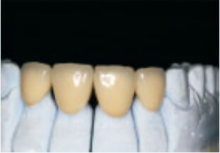 Beyaz yüksek soylu değerli alaşımlı taç ve köprü doğru ve özel